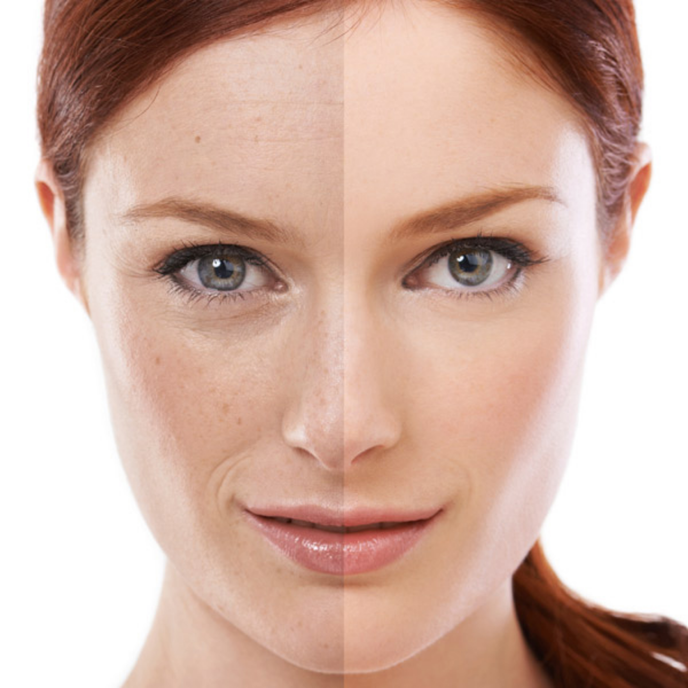 IPL Photofacial Skin Rejuvenation