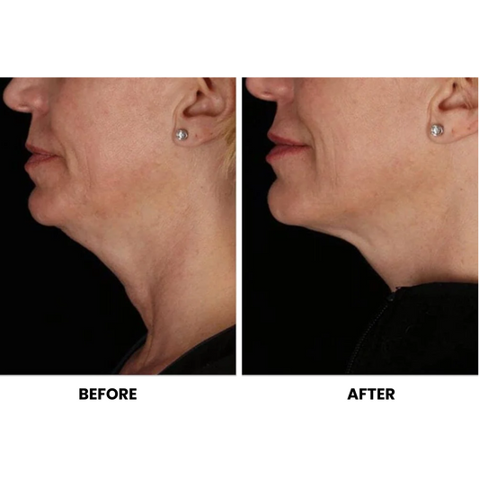 Matrix Pro RF Microneedling