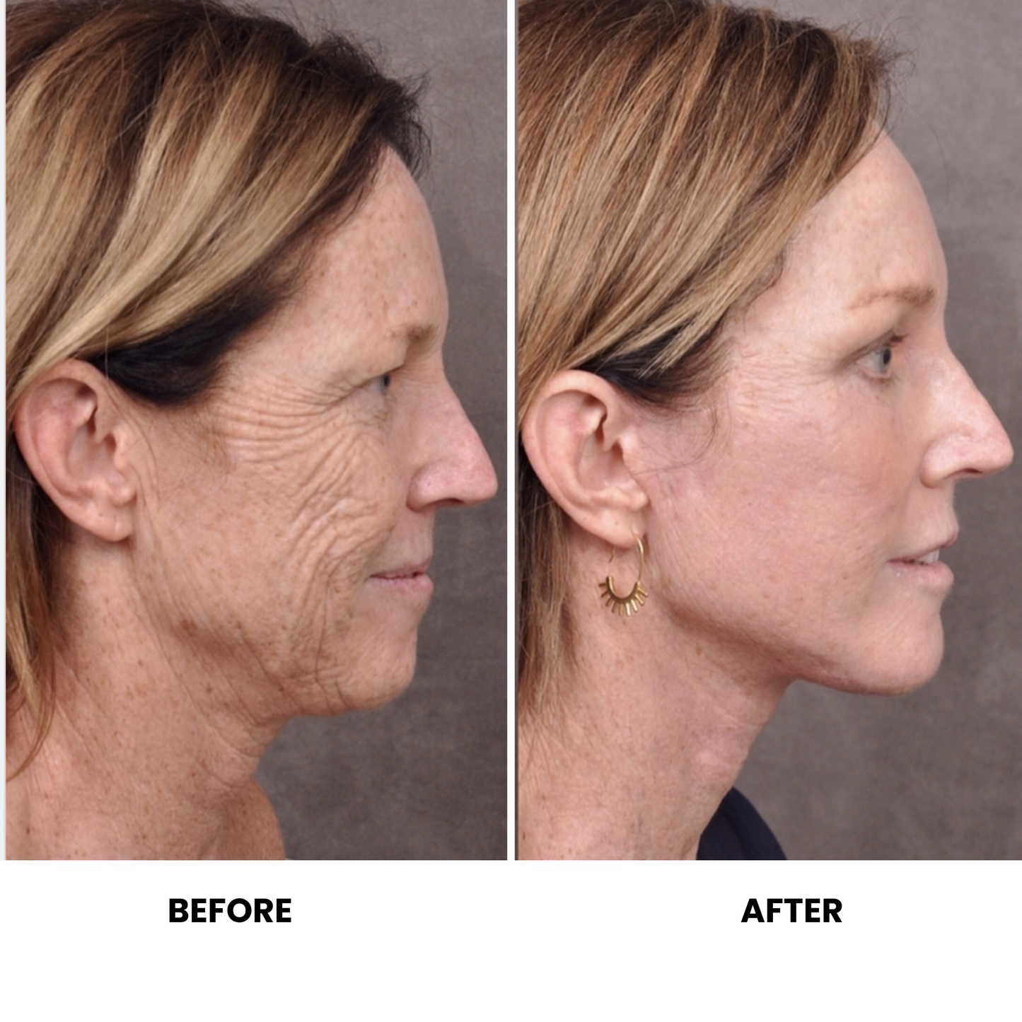 Matrix Pro RF Microneedling