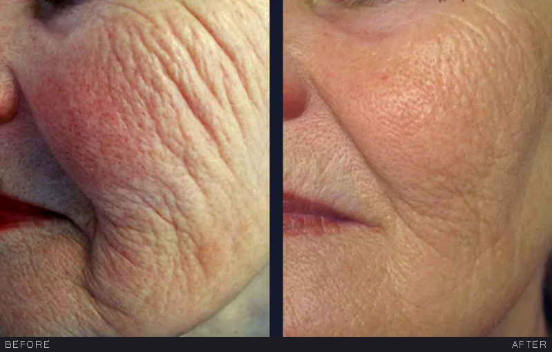 Matrix Pro RF Microneedling