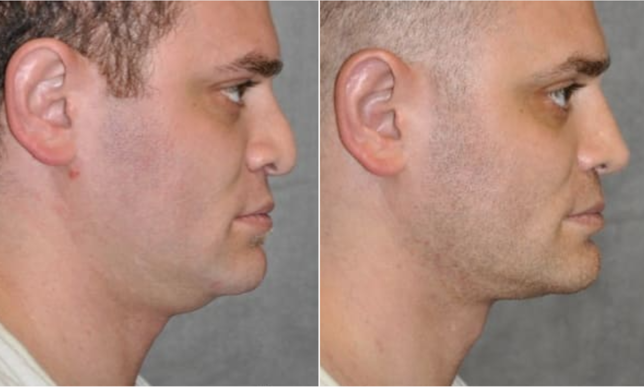 Matrix Pro RF Microneedling