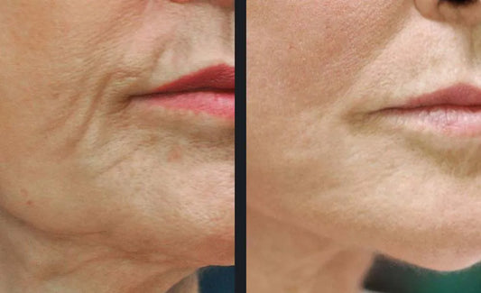 Morpheus 8 RF Microneedling (3 sessions)