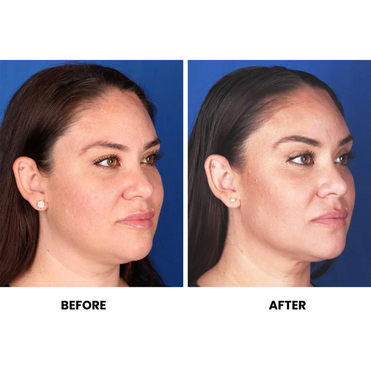 Morpheus 8 RF Microneedling (3 sessions)